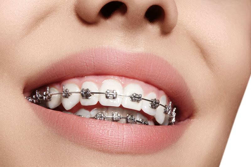 Braces