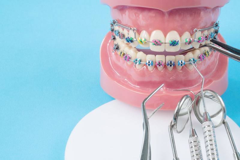 Braces