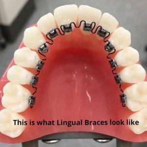 Hidden Braces  Lingual Braces (INBRACE) in Whittier, CA